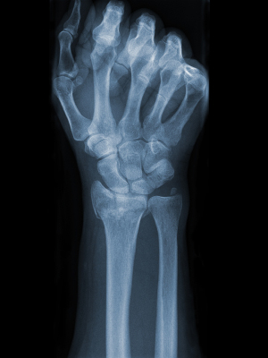 osteocalcina